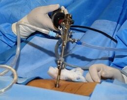 Chirurgiczne leczenie osteochondozy lędźwiowej