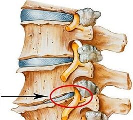 Dlaczego jest osteochondroza lędźwiowa