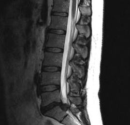 Opcje diagnostyczne osteochondrozy lędźwiowej