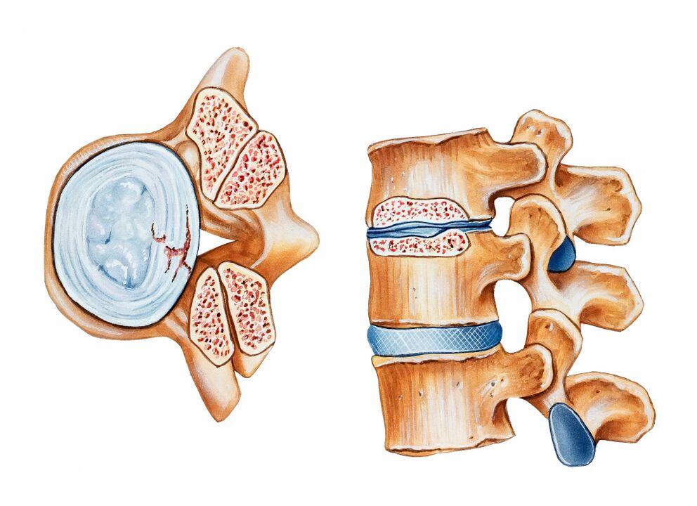 Osteochondroza regionu szyjnego prowadzi do zniszczenia dysków międzykręgowych