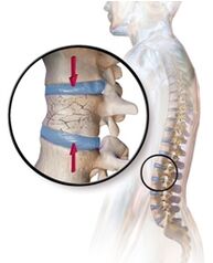 Osteoporoza wywołuje ból pleców w dolnej części pleców
