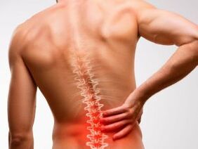 ból dolnej części pleców spowodowany osteochondrozą